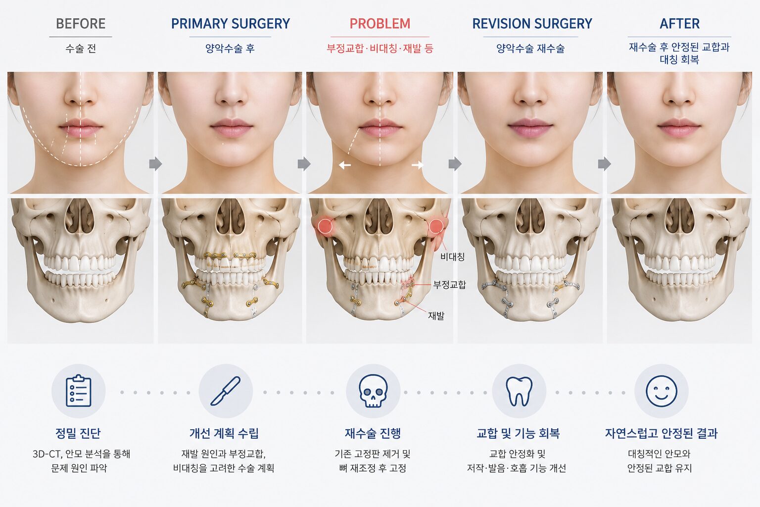 양악수술 재수술 원인과 예방을 설명하는 제아치과의원 자료 이미지