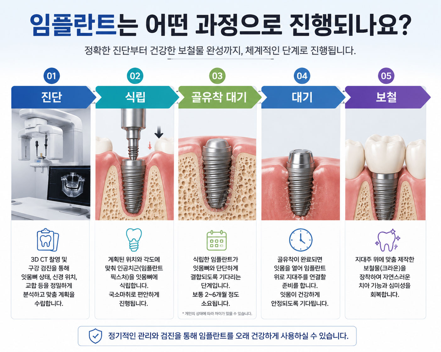 강남 임플란트 식립 과정을 설명하는 제아치과의원 자료 이미지